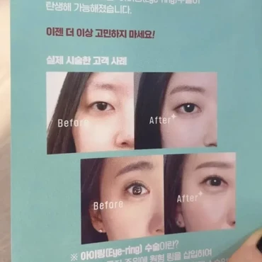 Operasi Plastik di Korea Selatan dan Thailand Jadi Tren, Ini Perbedaan dan Biayanya