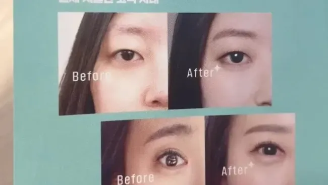 Operasi Plastik di Korea Selatan dan Thailand Jadi Tren, Ini Perbedaan dan Biayanya