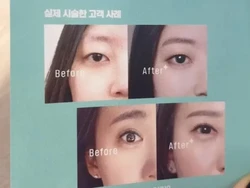 Operasi Plastik di Korea Selatan dan Thailand Jadi Tren, Ini Perbedaan dan Biayanya