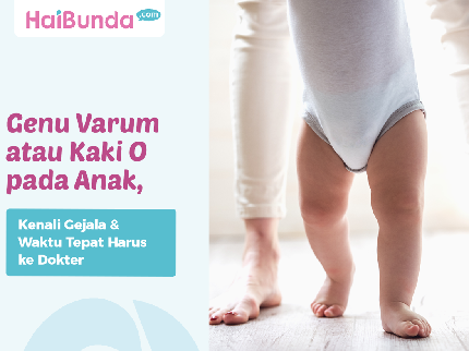 Genu Varum atau Kaki O pada Anak, Kenali Gejala & Waktu Tepat Harus ke Dokter