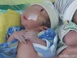 RSUD dr Iskak Tulungagung Tangani Bayi Kembar Siam Langka
