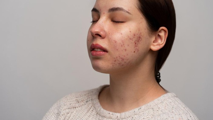 Ini Perbedaan Jerawat Hormonal dan Bakteri, Ketahui Agar Mendapatkan Perawatan yang Tepat!