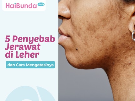 5 Penyebab Jerawat di Leher dan Cara Mengatasinya