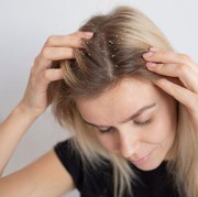 5 Cara Mengempaskan Masalah Ketombe Kering pada Rambut