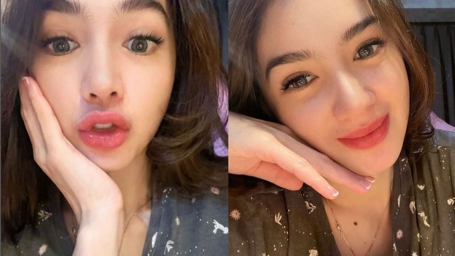 Wajah Angel Karamoy dua bulan setelah operasi plastik.