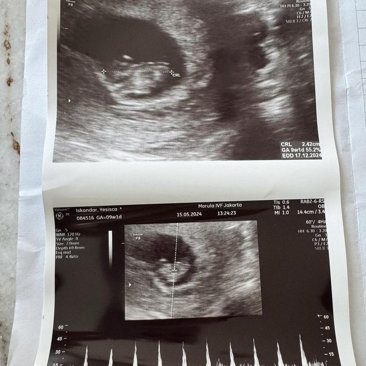 <p>Jessica Iskandar atau yang akrab disapa dengan Jedar saat ini sedang menjalani kehamilan anak ketiga. Kabarnya, Jedar dan Vincent memang ingin memiliki anak perempuan melalui program IVF. Tak ingin menyimpan rasa bahagia sendirian, Ibunda El Barack tersebut turut membagikan hasil USG miliknya untuk para penggemar. (Foto: Instagram @inijedar).</p>