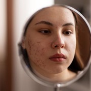 Cara Bijak Menghadapi Acne Shaming, Biar Nggak Bikin Sakit Hati!