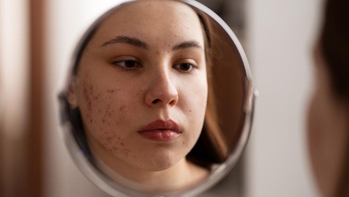 Cara Bijak Menghadapi Acne Shaming, Biar Nggak Bikin Sakit Hati!