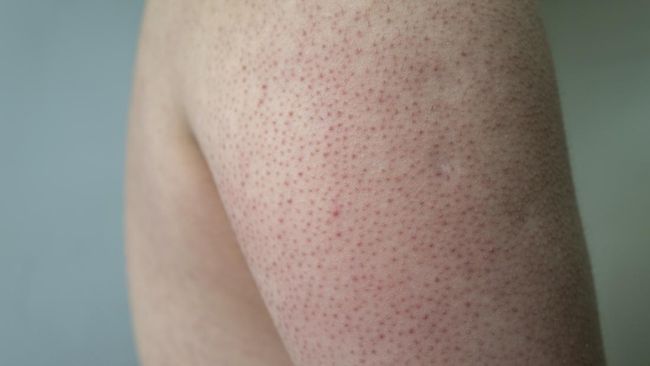 Keratosis pilaris alias chicken skin sangat mengganggu tampilan kulit. Simak cara mengatasi chicken skin dengan mudah.