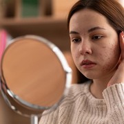 Saling Berkaitan, 5 Posisi Jerawat di Wajah Bisa Tentukan Kondisi Kesehatan Kamu