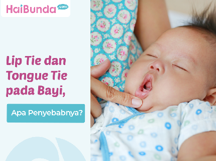 Lip Tie dan Tongue Tie pada Bayi, Apa Penyebabnya?