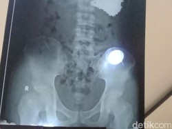 Potret 70 Paku Saat Bersarang dan Usai Diangkat dari Lambung Pria Indramayu