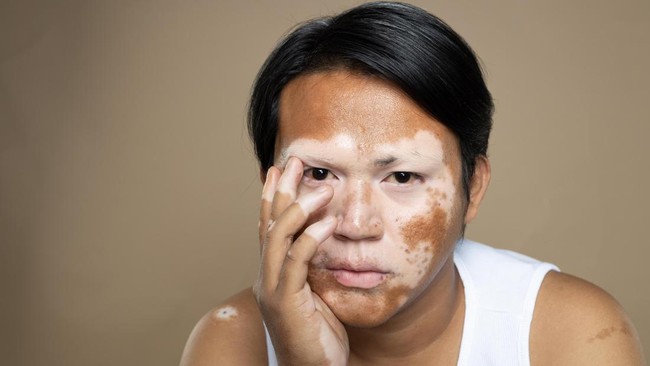 Menerima vitiligo sebagai bagian dari diri bukan hal mudah. Namun, Itang (28) mampu melalui perjalanan panjang ini sampai menganggap vitiligo sebagai keajaiban.