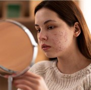 4 Kebiasaan yang Menjadi Penyebab Bekas Jerawat Susah Hilang, Kamu Sering Lakukan?