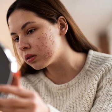 Kenapa Jerawat Selalu Muncul? Ini 5 Faktor yang Perlu Kamu Tahu