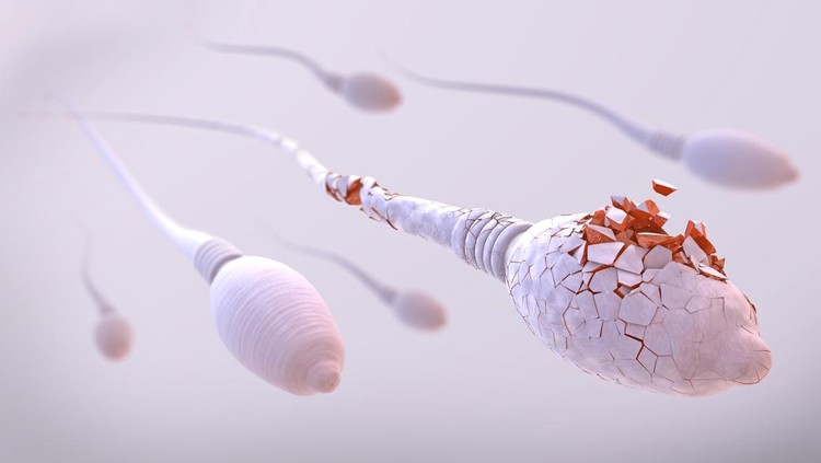Teratozoospermia Teratozoospermia