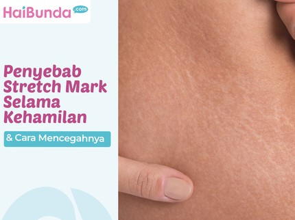 Penyebab Stretch Mark Selama Kehamilan & Cara Mencegahnya