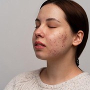 Kulit Kering dan Jerawatan Saat Cuaca Panas? Tenang, Ini Solusinya!