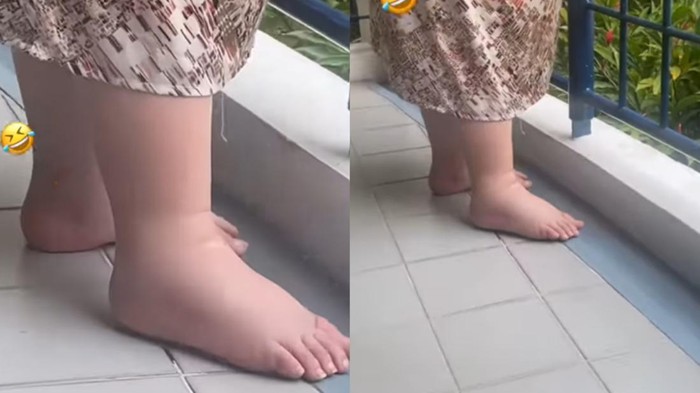 Kaki Istri Denny Sumargo Bengkak