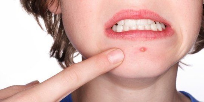 5 Tanda Jerawat Kamu Mau Sembuh, Jangan Sering Dipegang!