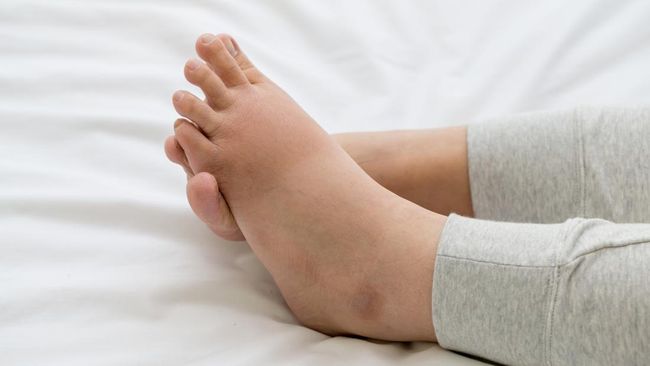Kaki bengkak bisa terjadi karena ginjal yang bermasalah. Bagaimana ciri-cirinya?