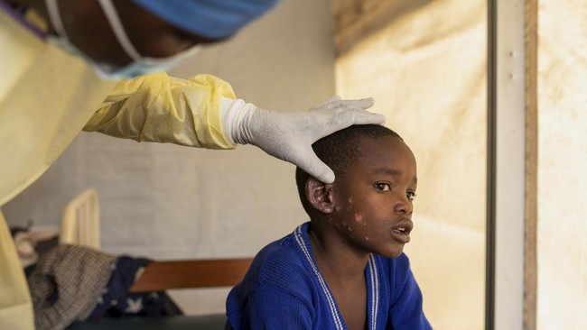 Afrika terus mencatat lonjakan kasus baru cacar monyet/monkey pox (mpox) hingga hampir 3.000 kasus baru dalam sepekan terakhir dengan korban jiwa meningkat.