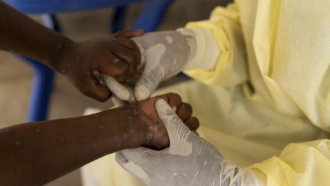 WHO considers Mpox Outbreak Status as an international emergency