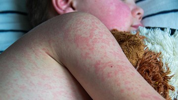 PENYAKIT POLIO DAN LAINNYA