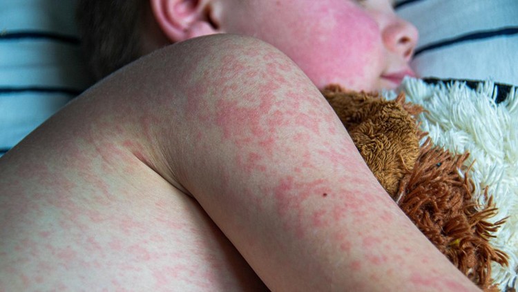 Viral disease. Measles rash on the body of the child. Allergy.