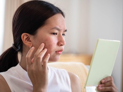 Bekas Jerawat PIE dan PIH, Ini Perbedaan dan Kandungan Skincare untuk Mengatasinya