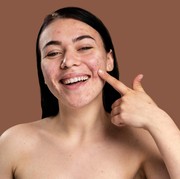 5 Kebiasaan yang Membuat Kulit Wajah Iritasi dan Mudah Berjerawat