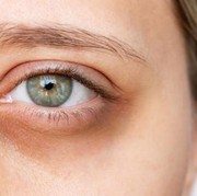 4 Cara Mudah Mengatasi Mata dengan Bahan Alami yang Ada di Rumah, Yuk Cobain!