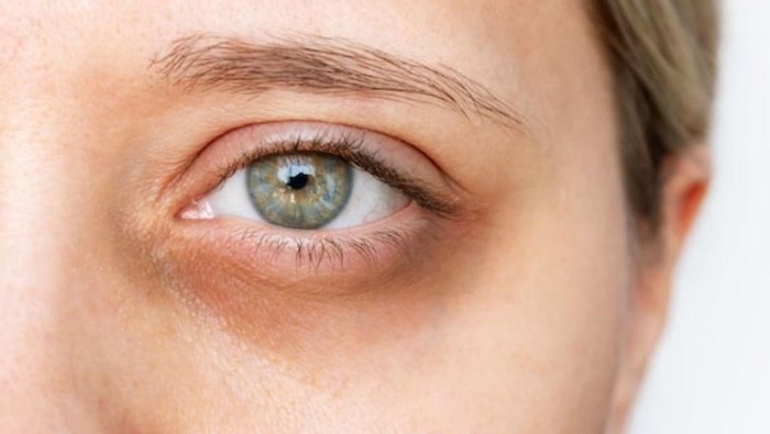 4 Cara Mudah Mengatasi Mata dengan Bahan Alami yang Ada di Rumah, Yuk Cobain!