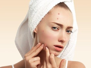 Mengatasi Jerawat dengan Acne Patch, Apakah Efektif?