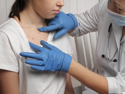 WHO Kembali Umumkan Wabah 'Cacar Monyet' MPox Darurat Kesehatan Global