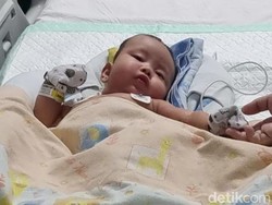 Begini Sulitnya Operasi Pemisahan Bayi Kembar Siam Tulungagung