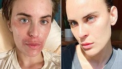 Begini Wajah Anak Demi Moore Usai Alami Gangguan Kelupas Kulit Sendiri