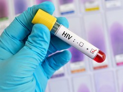 30 Peserta Pesta Gay di Puncak Reaktif HIV-Sifilis, Apa Sih Artinya? Ini Kata Dokter