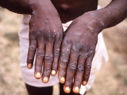 Thailand Umumkan Kasus Mpox Mematikan Pertama di Asia, Apa Gejalanya?