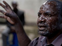 Lima Hal yang Membedakan Mpox dengan COVID-19