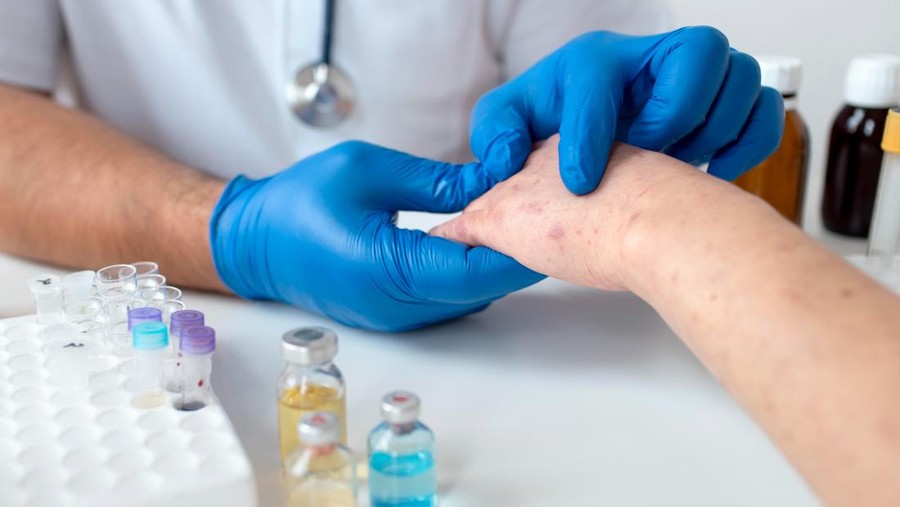 7 Gejala Virus Mpox atau Cacar Monyet yang Mulai Mewabah di Indonesia