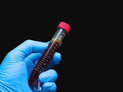 Menkes Ungkap Sumber Utama Penularan Mpox di Indonesia