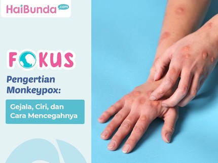 Pengertian Monkeypox: Gejala, Ciri, dan Cara Mencegahnya