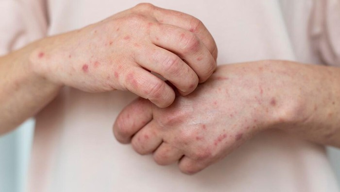 Ilustrasi alergi kulit/Foto: Freepik.com/freepik