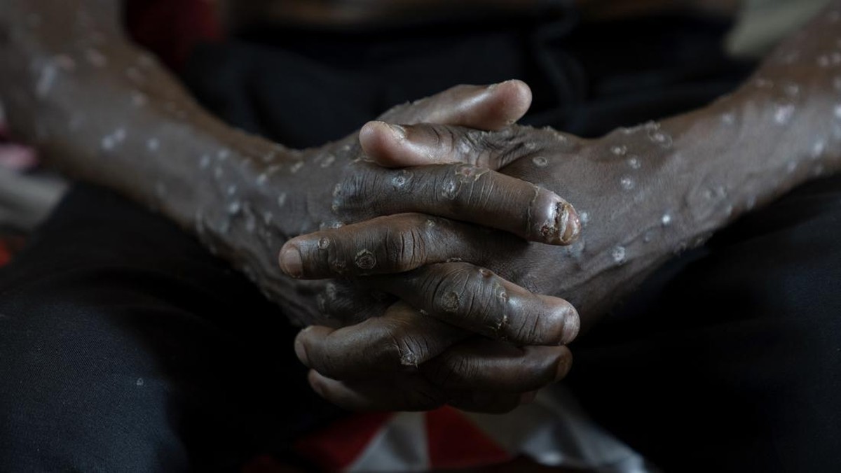 Kasus Mpox Naik di Negara Tetangga RI, Banyak Orang 'Main Sembarangan'
