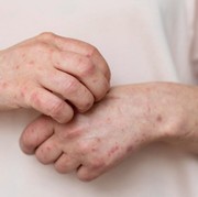 Apa Itu Monkeypox? Ini Gejala, Penyebab, dan Pengobatannya