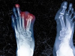 Foto Makanan Siasati Tagihan Nakal hingga Kaki Diamputasi Gegara Curi Makanan