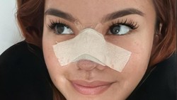 Shafa Harris Ungkap Kondisi Terkini setelah Jalani Operasi Plastik di Thailand