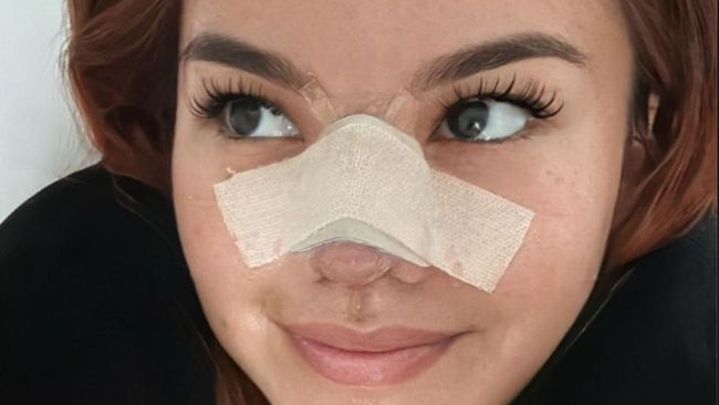 Shafa Harris Ungkap Kondisi Terkini setelah Jalani Operasi Plastik di Thailand