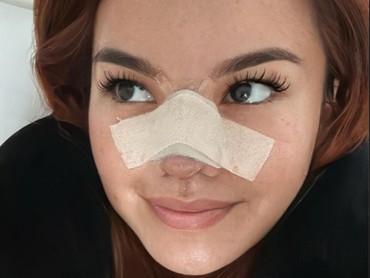 img-title Shafa Harris Ungkap Kondisi Terkini setelah Jalani Operasi Plastik di Thailand